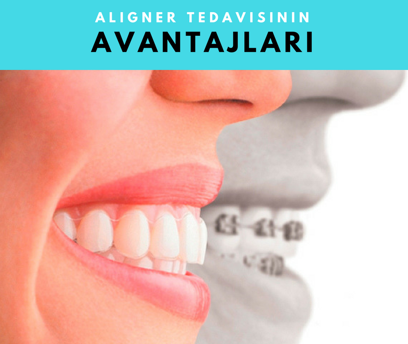 Aligner Avantajları